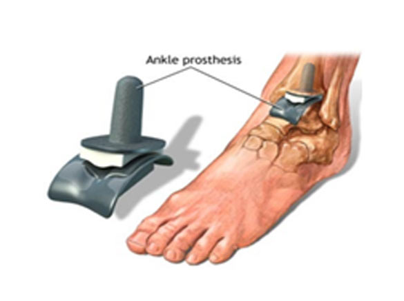 Ankle Replacement