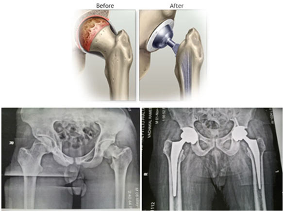 Hip Replacement
