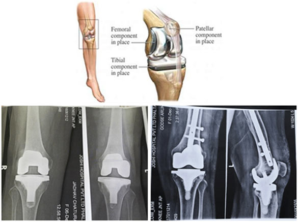 Knee Replacement