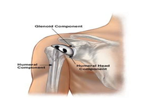 Shoulder Replacement